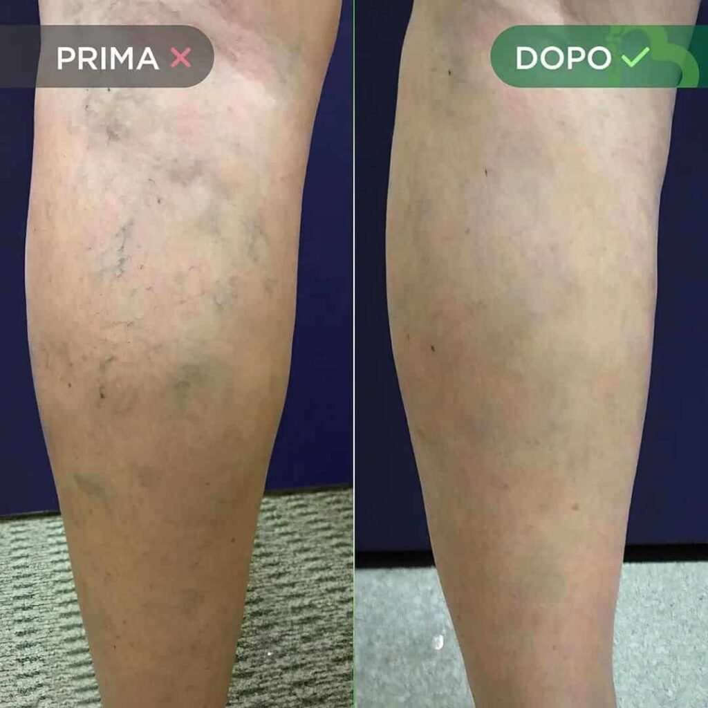 CREMA-VENE-VARICOSE-E-CAPILLARI-7-min.jpg