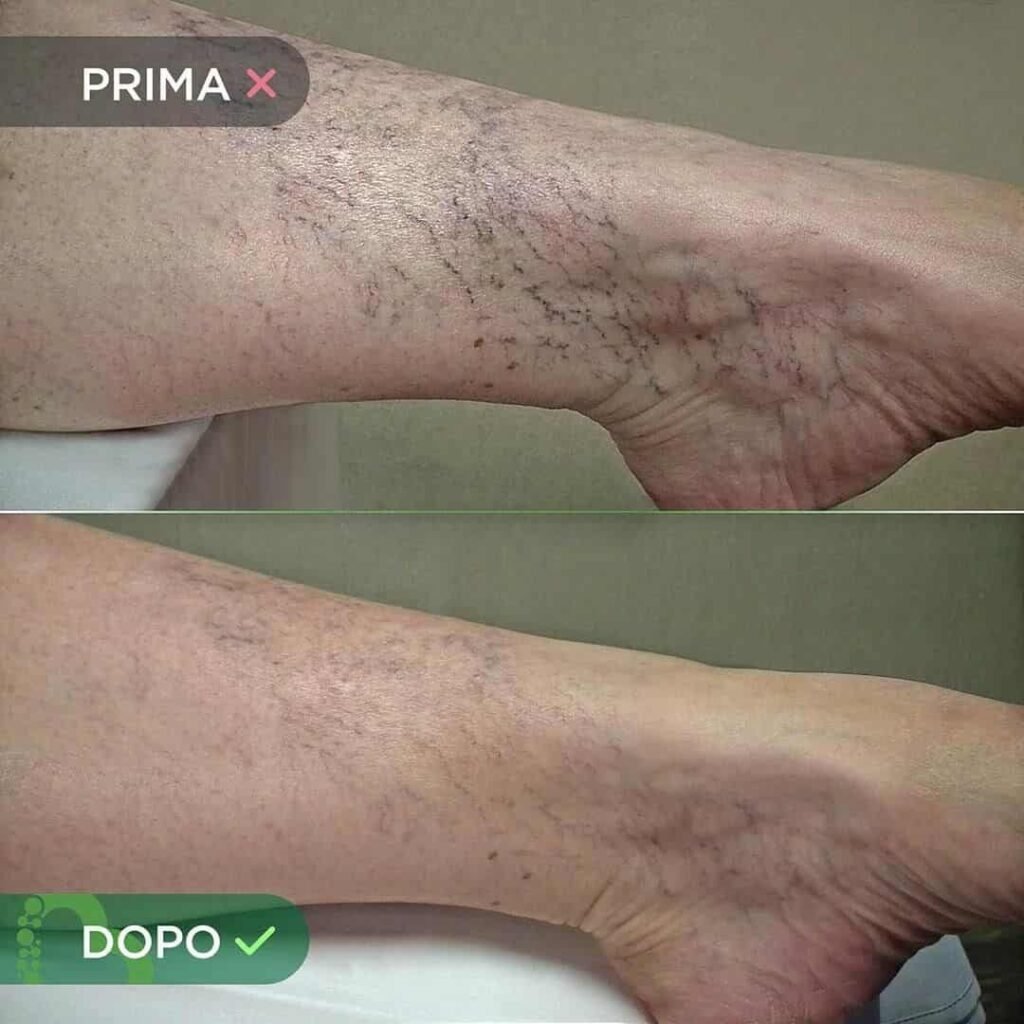 CREMA-VENE-VARICOSE-E-CAPILLARI-8-min.jpg